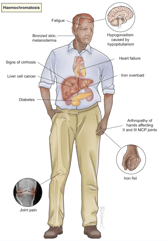 Hemocromatose